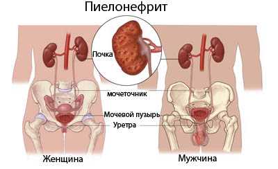 pielonefrit_1.jpg