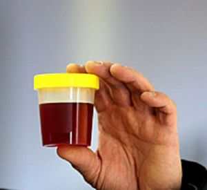 эритроциты в моче